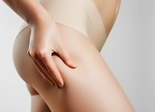 Cellulite behandeln Wiesbaden Dehnungsstreifen