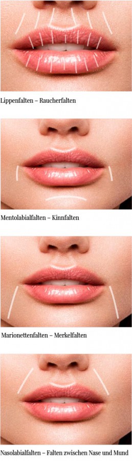 Lippenfalten Mundfalten Darstellung Wiesbaden