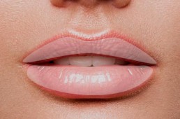 Lippenvolumen aufbauen Filler Wiesbaden